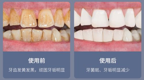 告別刷牙盲區(qū)，現(xiàn)代口腔護(hù)理新選擇 為何它能解決你的深層困擾